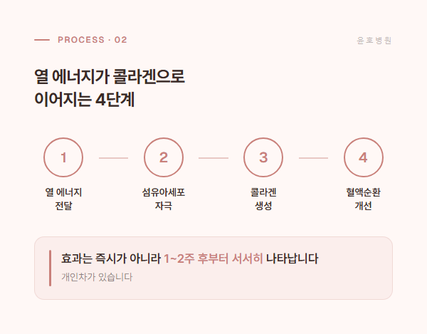 질레이저 시술의 4단계 작동 원리: 열 에너지 전달, 섬유아세포 자극, 콜라겐 생성, 혈액순환 개선